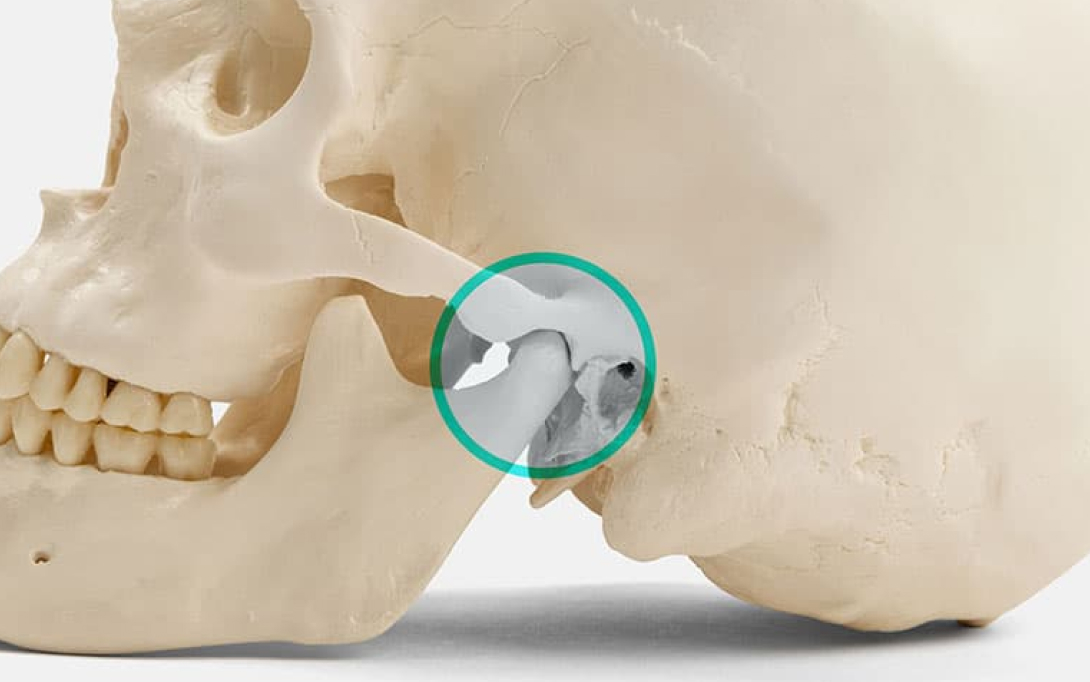 model of jawbone with circle around swollen area