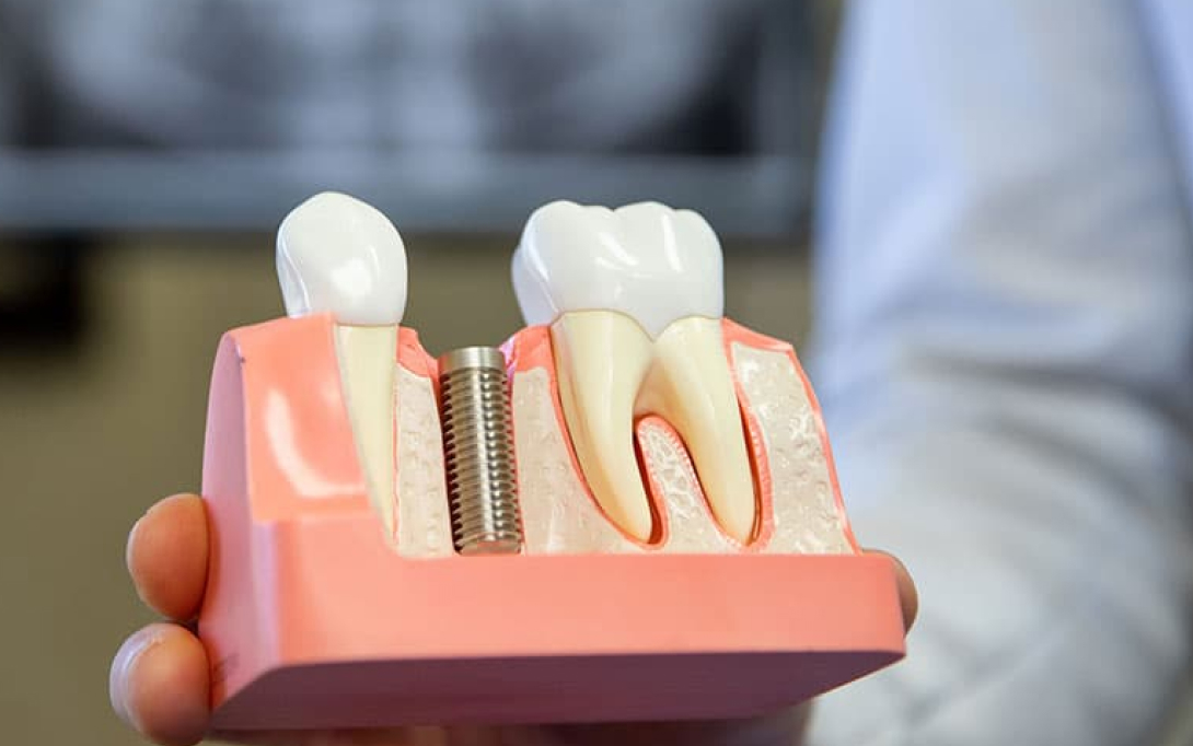 dentist holding up model of dental implants
