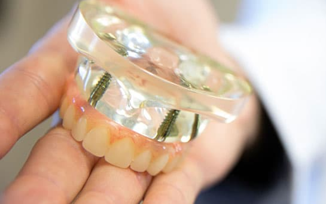 dental implants model