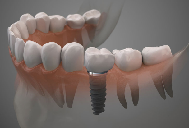 dental implant 3d model