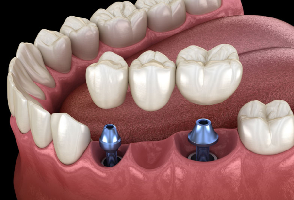 dental bridge implants 3d model