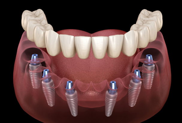 full mouth dental implants model 3d