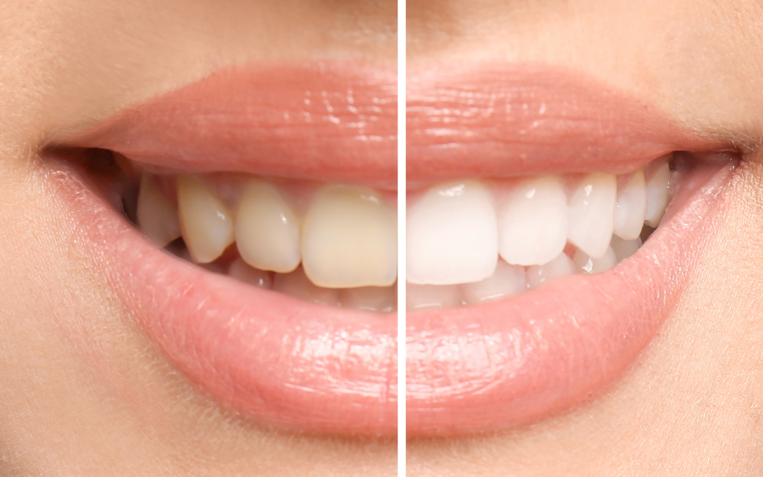 before and after dental procedure