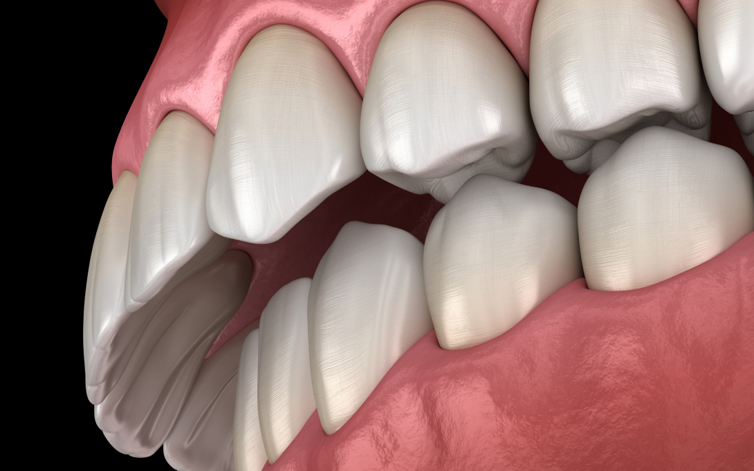 overbite 3d model