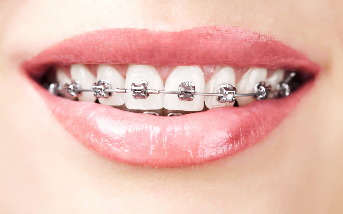 braces close up shot