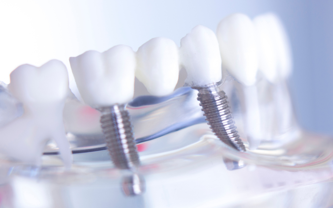 dental implants model