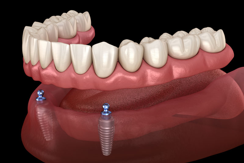 implant supported dentures 3d model