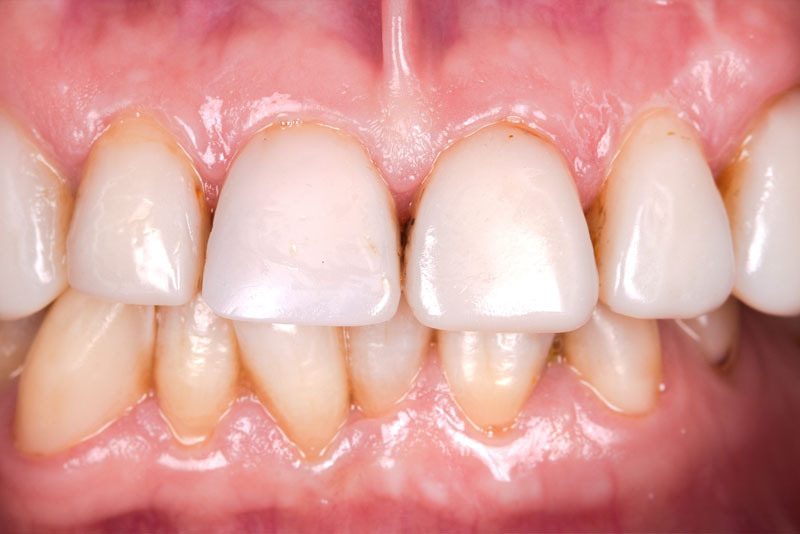 before dental procedure