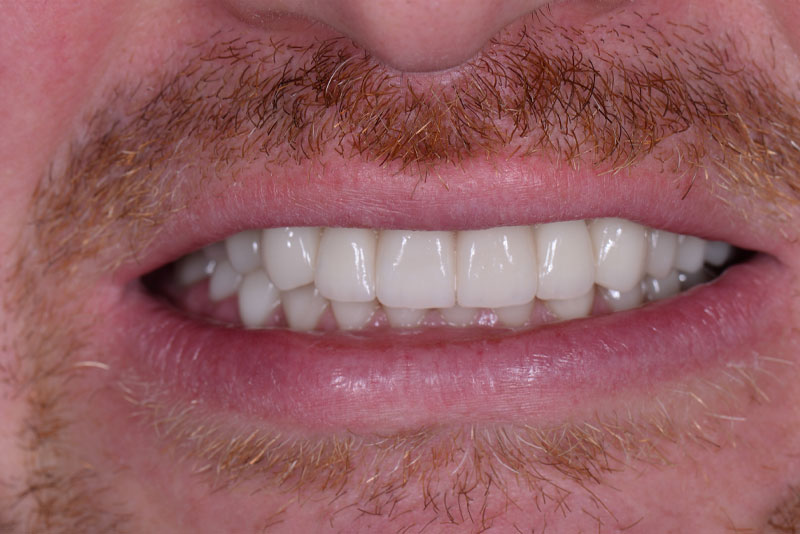 after dental procedure