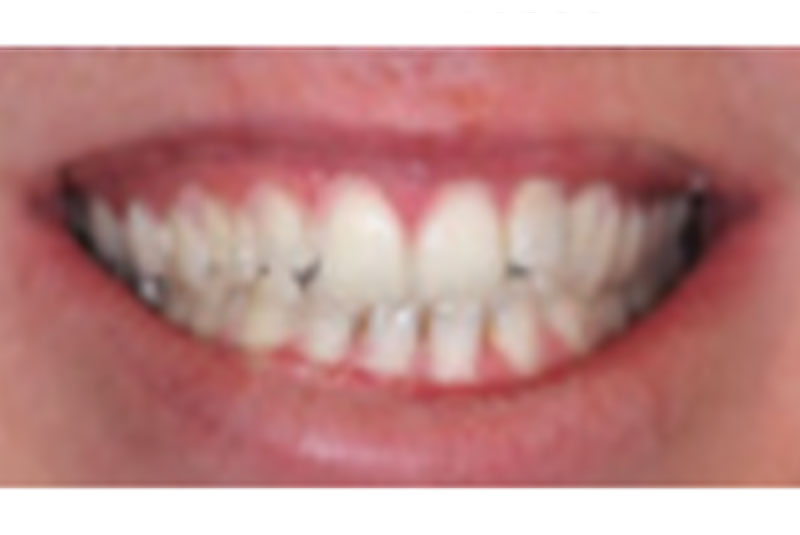 after before veneers and bridges