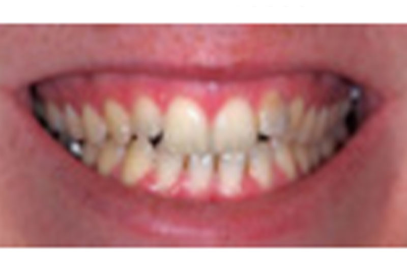 before before veneers and bridges